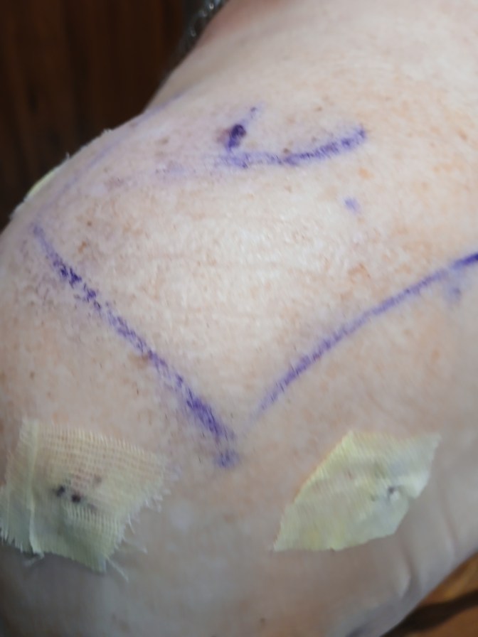 His repeated shoulder surgery for a torn rotator cuff(Physical Therapist tore the first one apart that had been done in March) Surgery was just about 3 weeks ago now.  3 holes is how they do ours here in New England but lots of pain and not much use until it heals. Fingers crossed the next PT person does a much better job. 